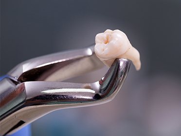 Clasp holding extracted tooth